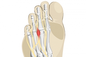 Morton’s Neuroma and High Heels