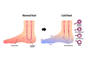 Raynaud’s Phenomenon