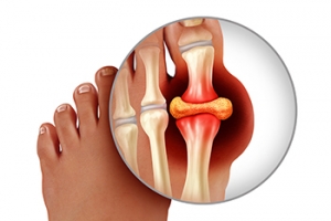 Preventing Gout Flare-Ups