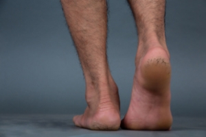 Understanding and Preventing Cracked Heels