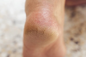 Is There a Link Between Diabetes and Cracked Heels?