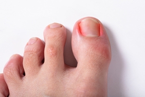 Ingrown Toenail Pain